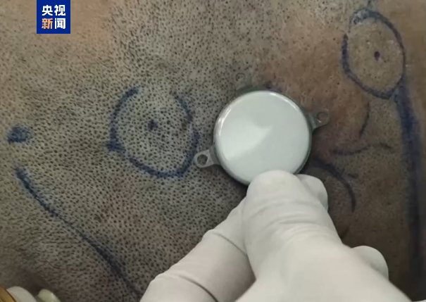 周末·关注丨截肢男子用意念玩赛车游戏 我国成功开展首例侵入式脑机接口临床试验(图1)